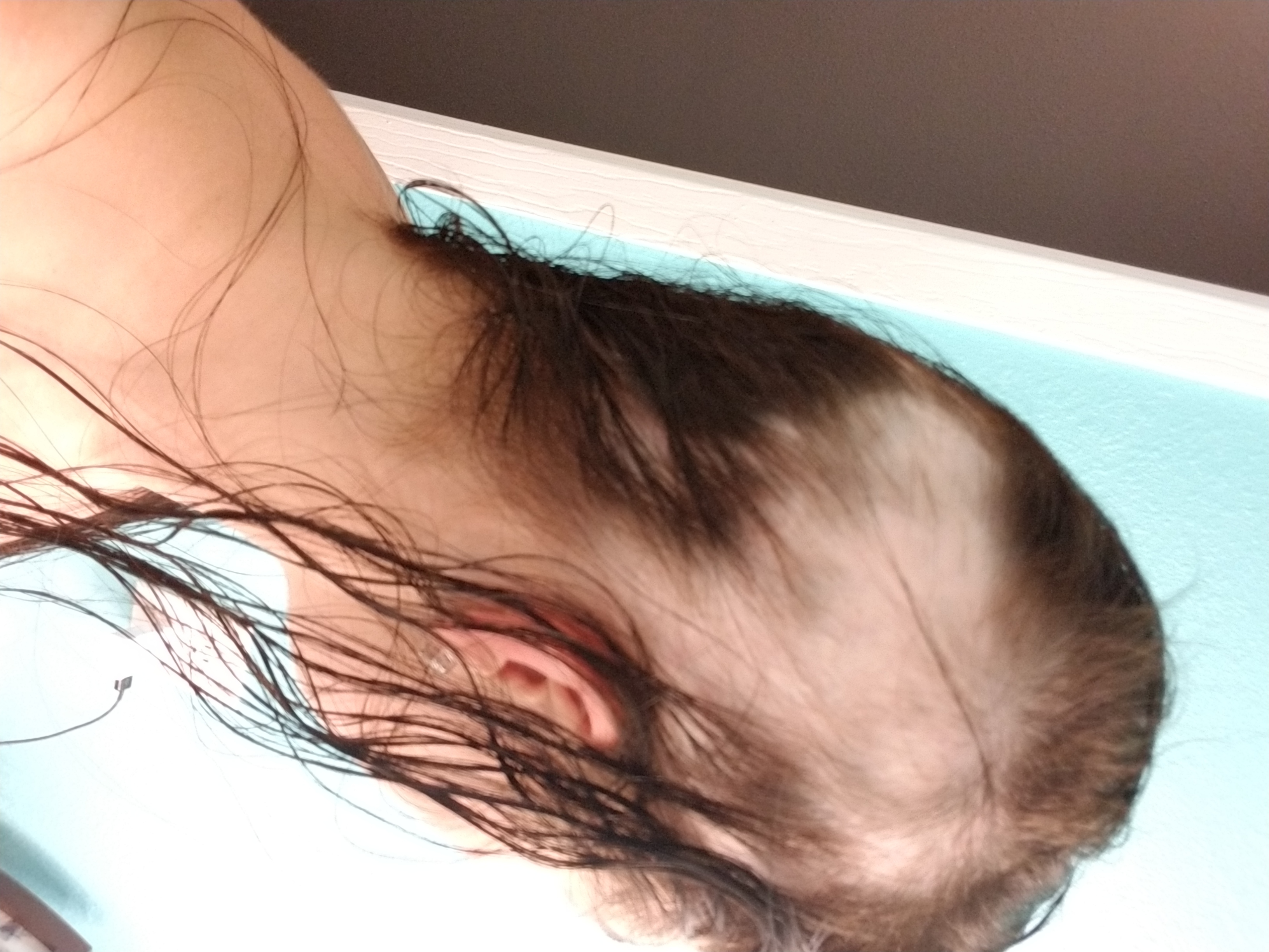 Example of alopecia areata
