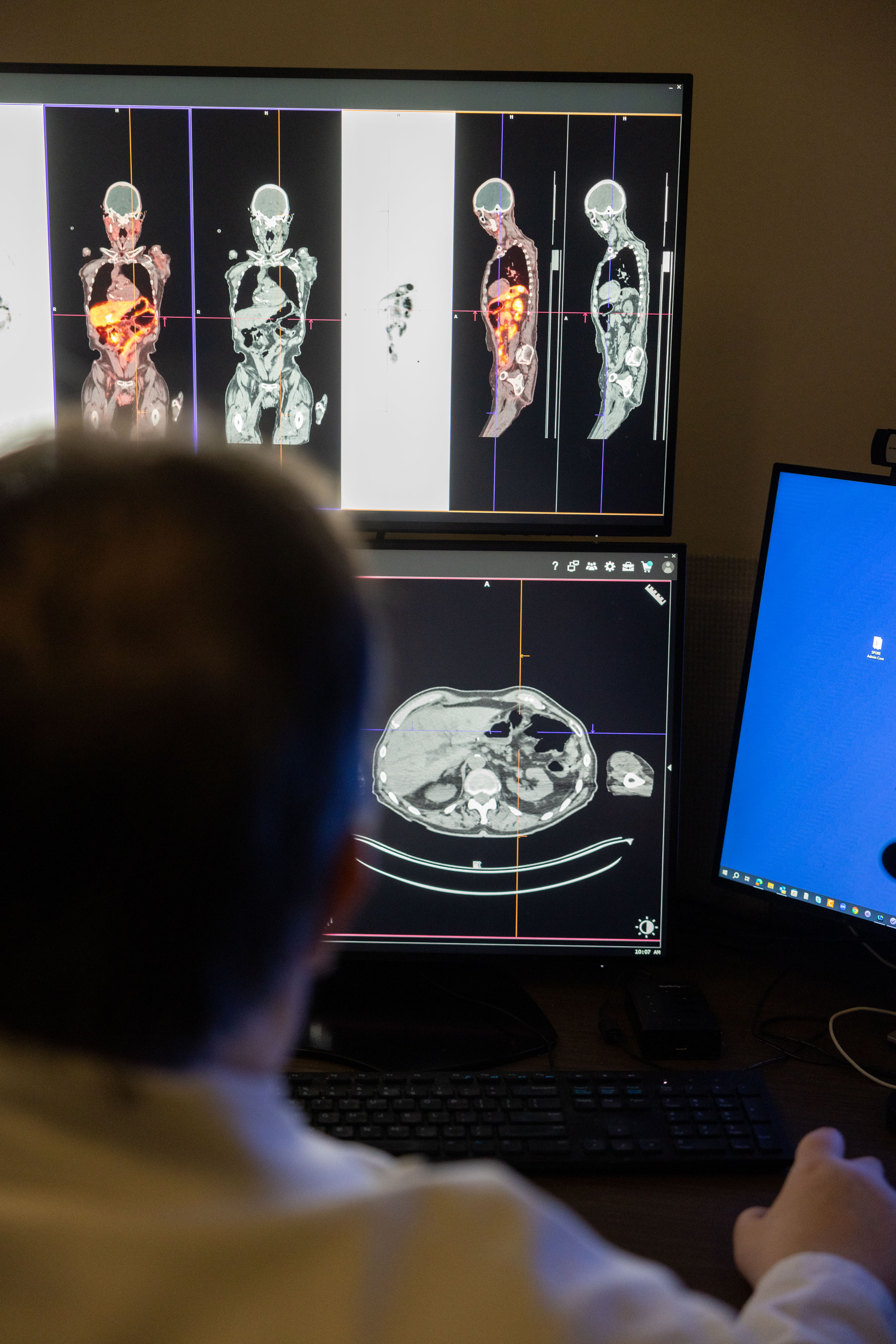 Theranostics uses quantitative imaging expertise to identify specific receptors on cancerous cells. This allows physicians to target only cancer cells and calculate the appropriate radiation dose for each patient.