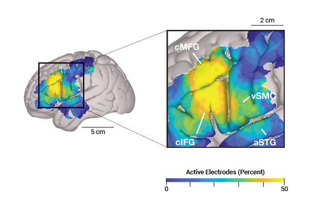 electrodes in the brain 