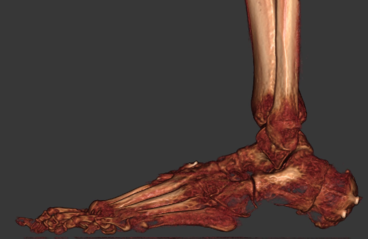 Reconstructed foot post surgery exterior view