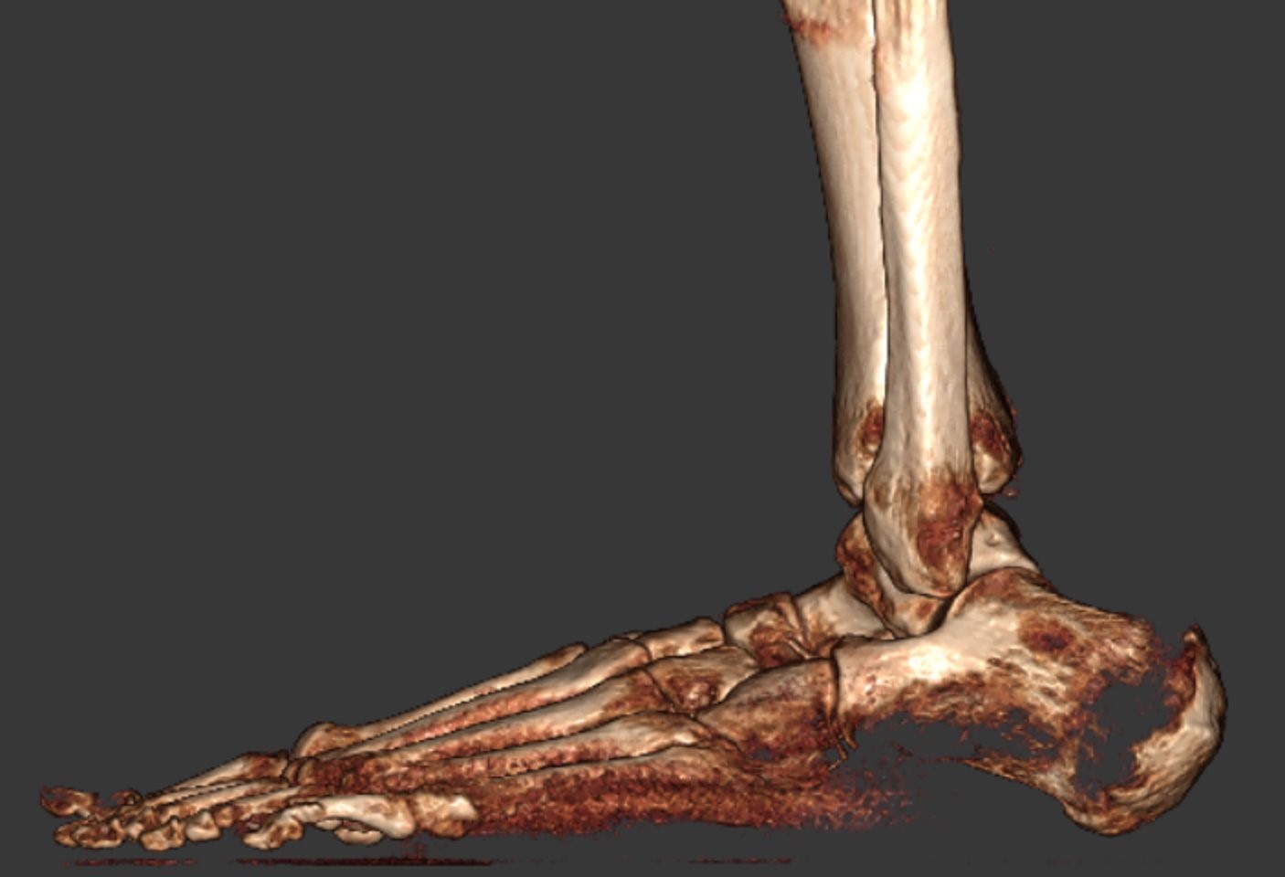 Reconstructed foot pre surgery exterior view