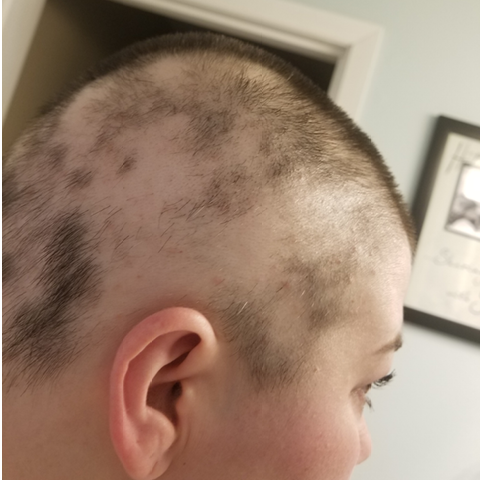 Cody Purvis' alopecia areat recovery progress
