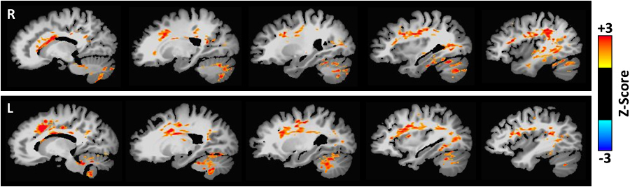 Iowa's approach to studying bipolar disorder includes imaging the same group of patients over time at different stages of their illness. These brain scans indicate areas with increased acidic pH in research participants with bipolar disorder.