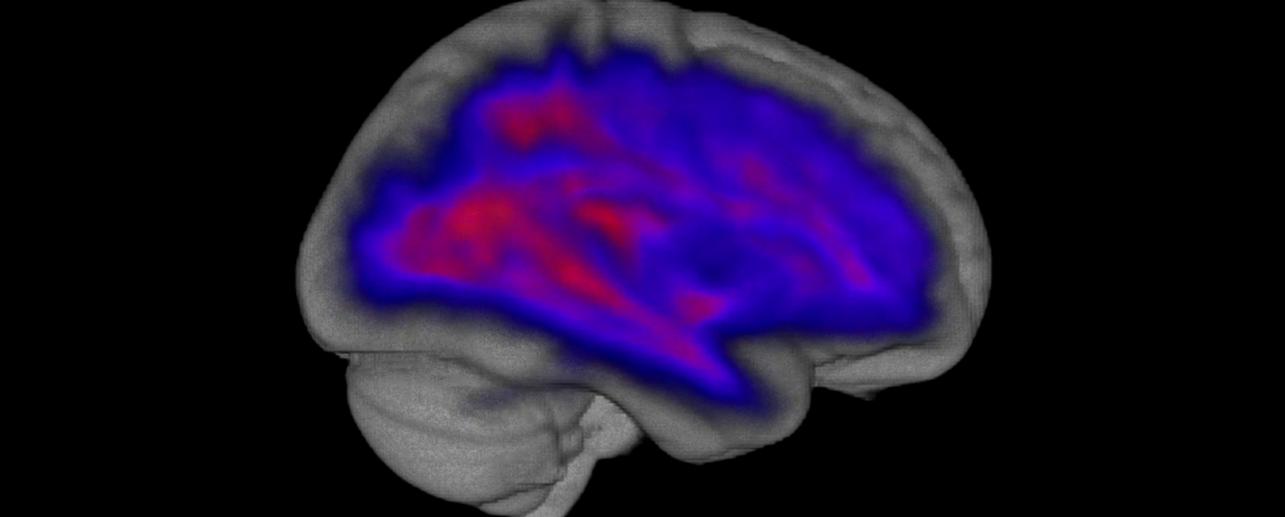 White matter vs gray matter