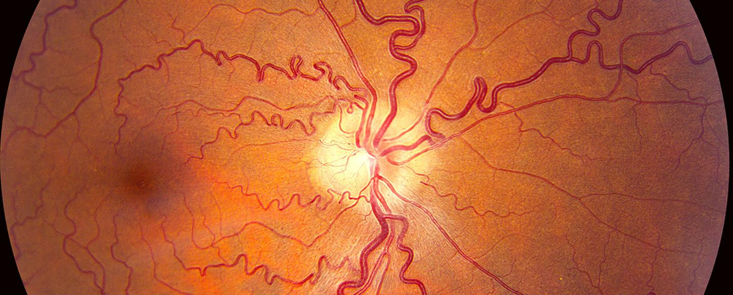 NF1 image by opthalmic photographer Dana Zach