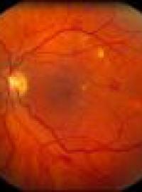 Nonproliferative diabetic retinopathy