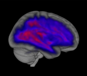 White matter vs gray matter