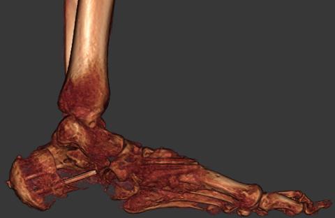 Reconstructed foot post surgery inteior view