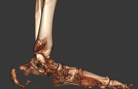 Reconstructed foot pre surgery interior view