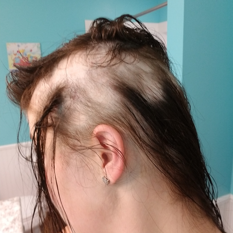 Side profile of Cody Purvis' alopecia areat