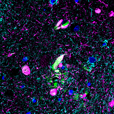 tangles and neuritic plaques in Alzheimer’s disease are amyloids because the magenta and green staining overlap.
