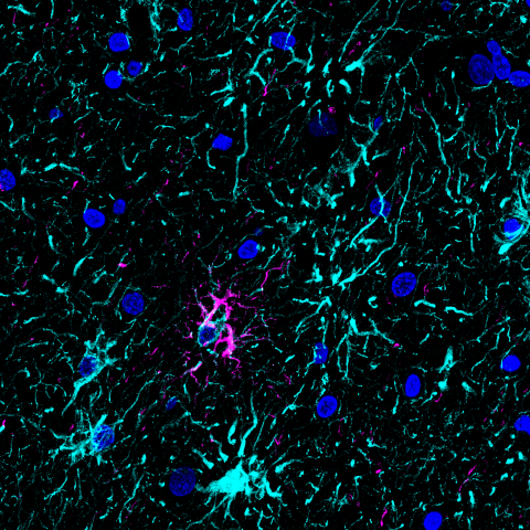 Brain cortex image of a patient with Progressive Supranuclear Palsy (PSP)